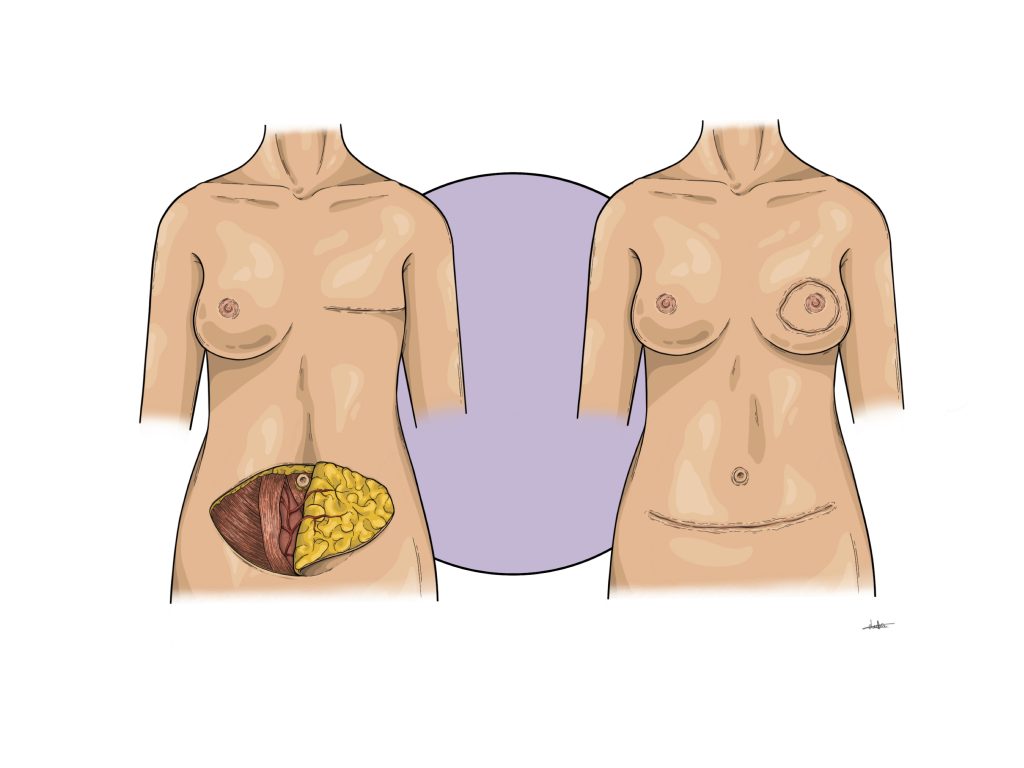 Ilustración de dos cuerpos femeninos: un antes y después de una cirugía reconstructiva de mama