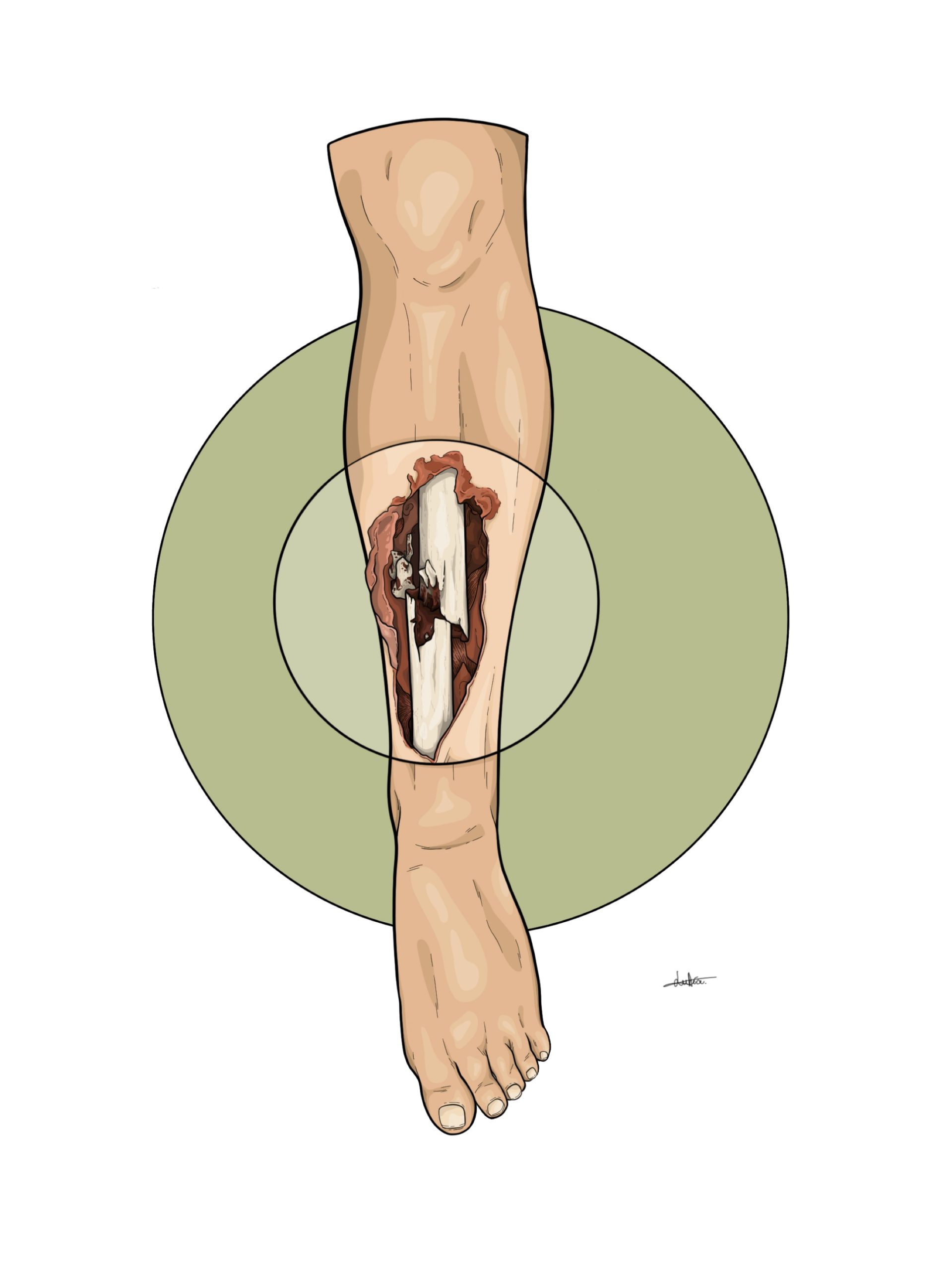 Ilustración de una pierna con un hueso fracturado.