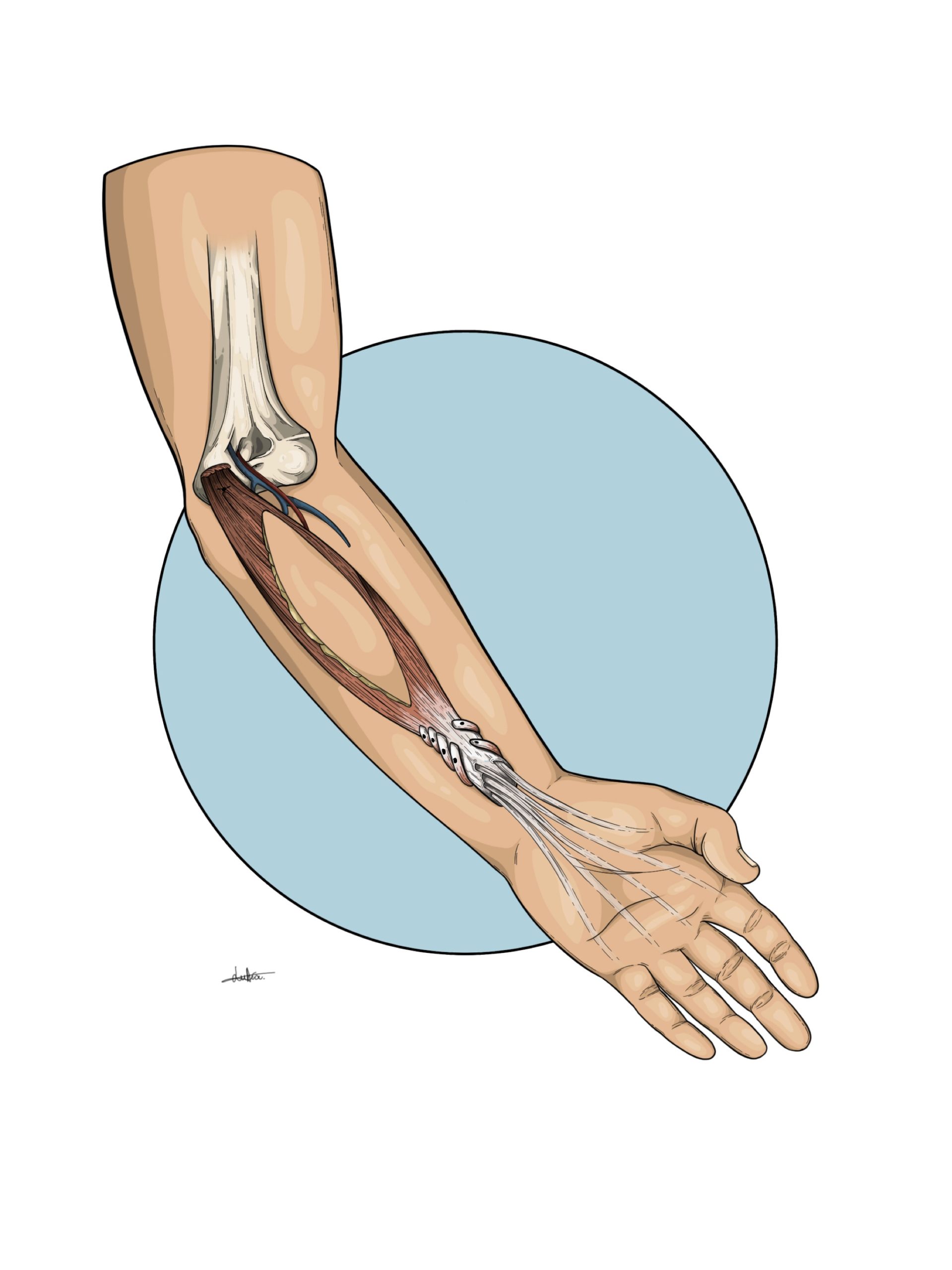 Ilustración de un brazo reconstruido tras una cirugía reconstructiva
