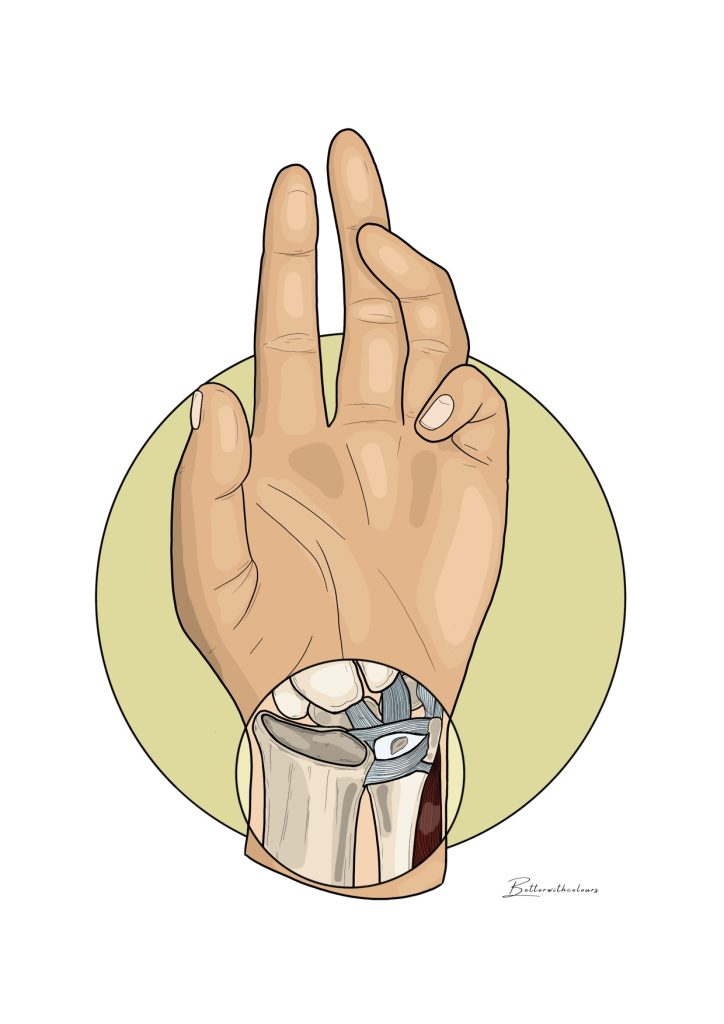 Ilustración de una mano con lesiones de fibrocartílago