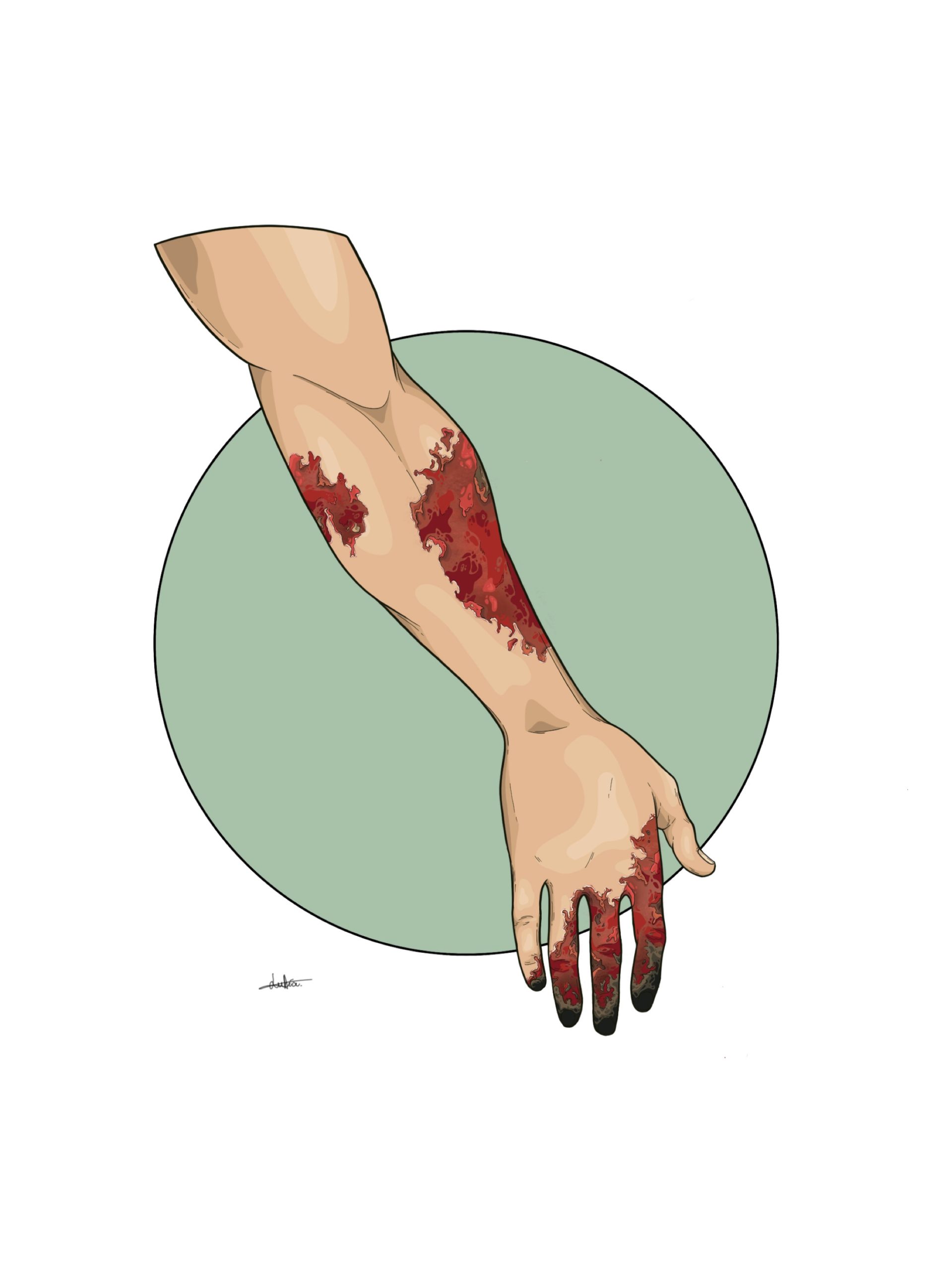 Ilustración de brazo con quemaduras