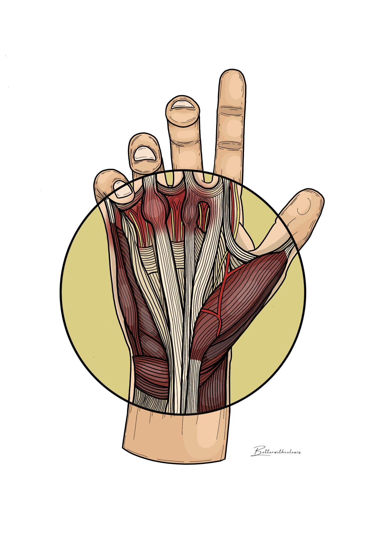 Ilustración de una mano con la enfermedad de Dupuytren