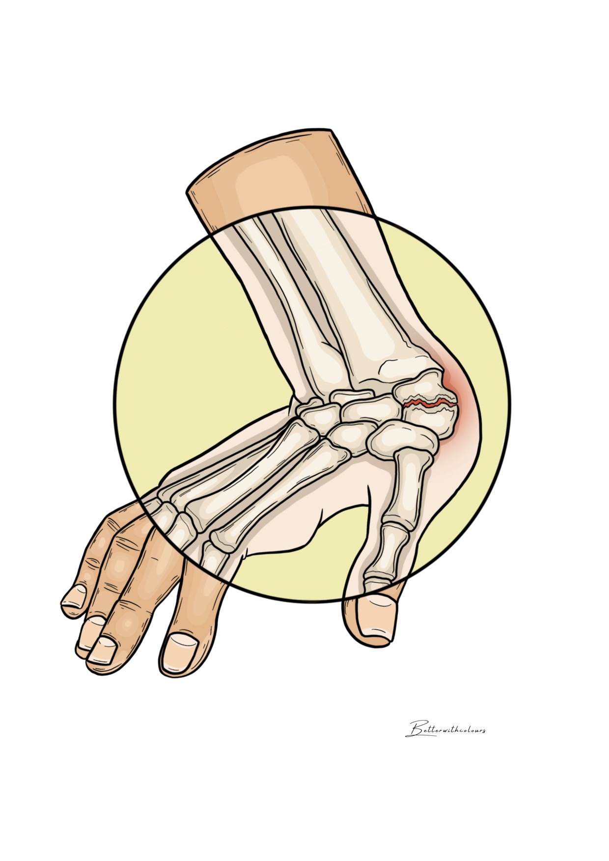Ilustración de una mano apoyada con un pequeño hueso fracturado.