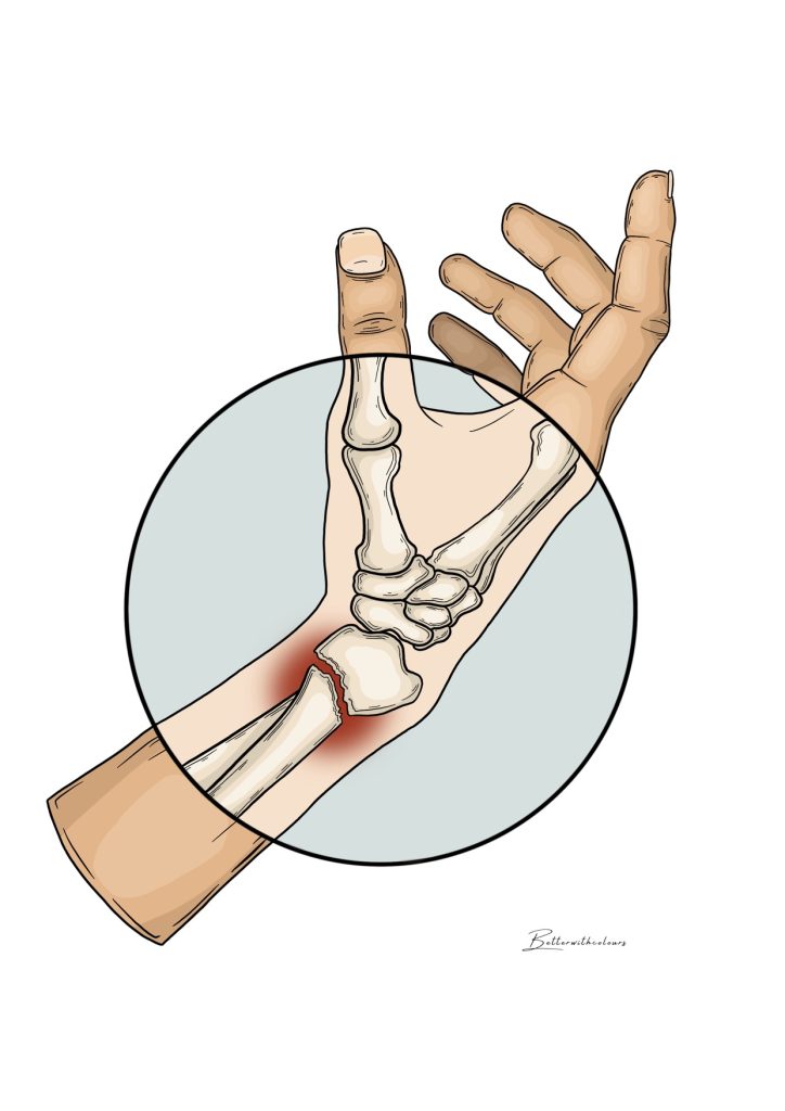 Ilustración de una mano humana, que irradia dolor en la muñeca, debido a una fractura.