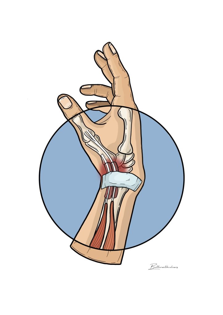Ilustraciñon de una mano con lesiones tendinosas.