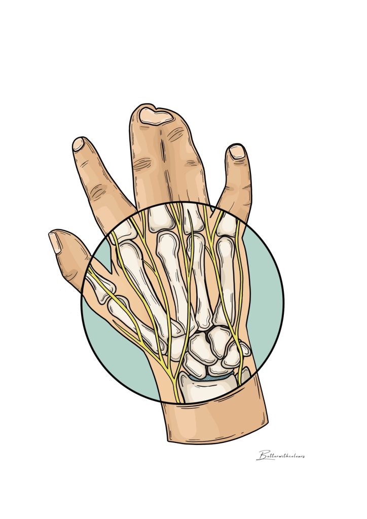Ilustración de una mano congénita