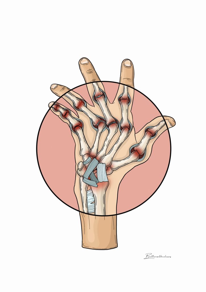 Ilustración de una mano reumática.