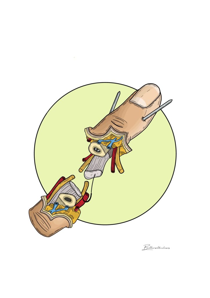 Ilustración de un dedo partido por la mitad en el que se observan: huesos, tejidos, arterias, etc.