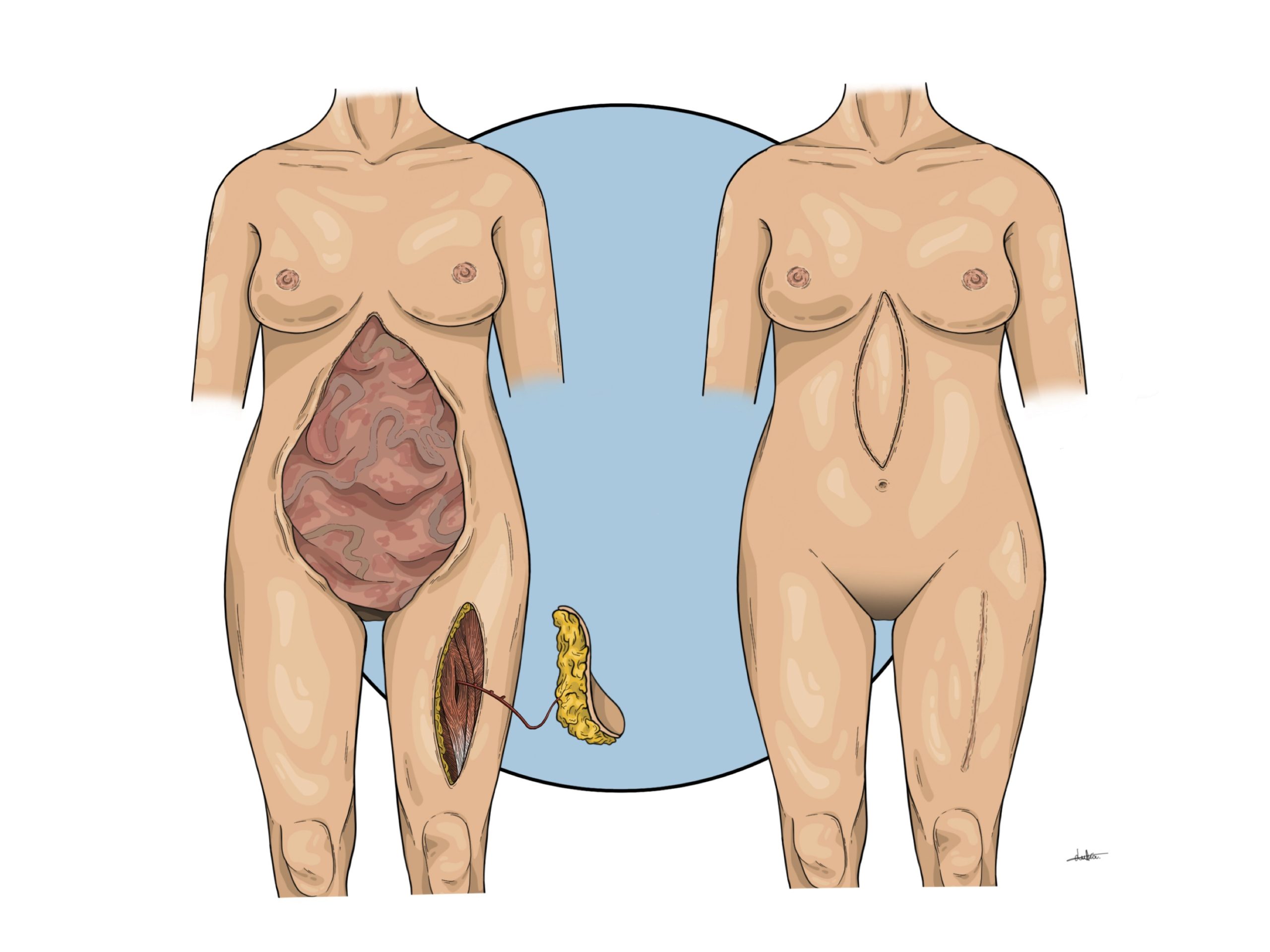 Ilustración de cuerpo humano de mujer en una cirugía reconstructiva.
