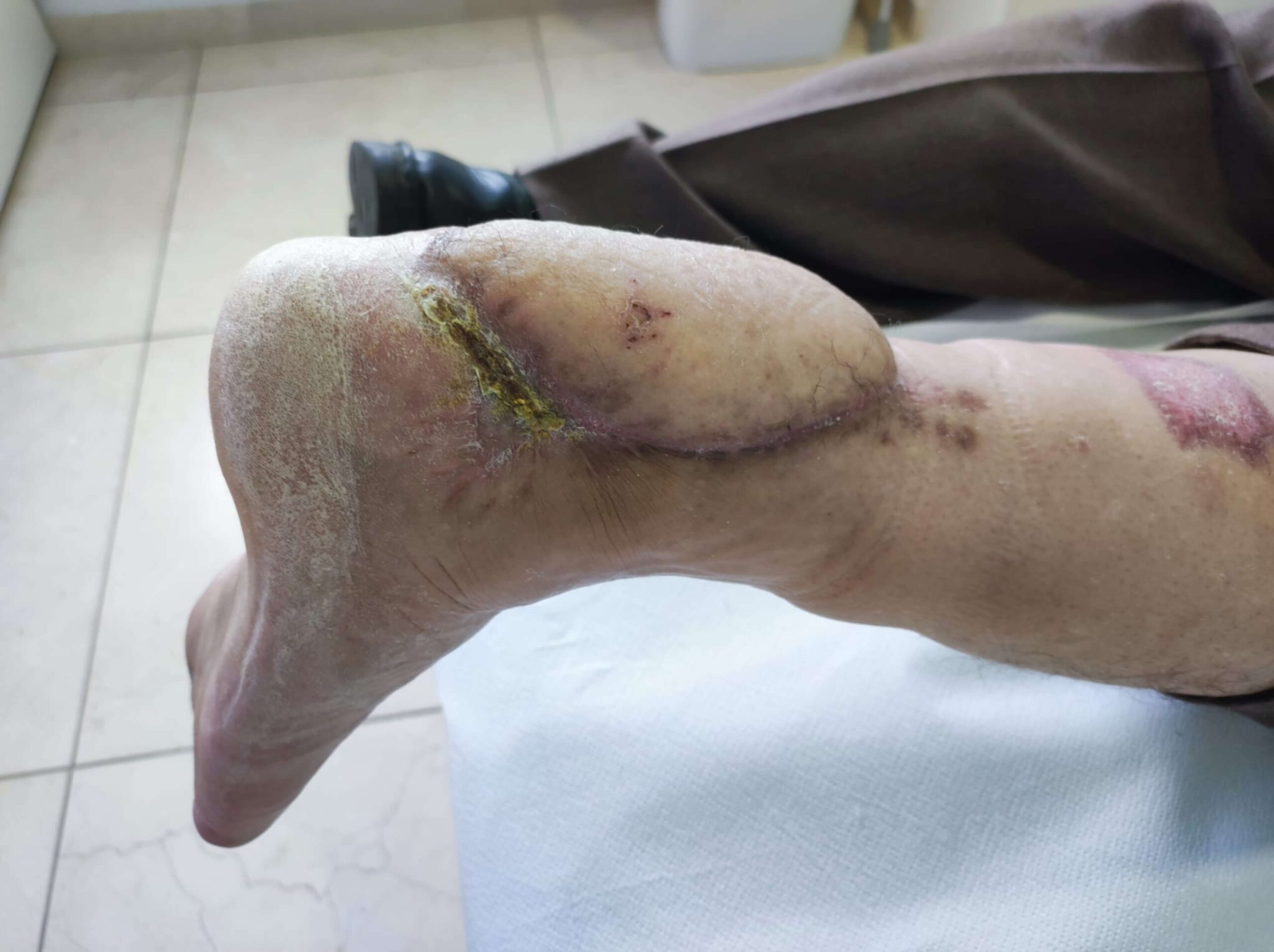 Parte posterior del pie, recuperandose de una operación de varias semanas